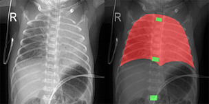 신생아 삽관 기준점, AI로 잡는다…흉추 자동 인식 연구 결과 발표