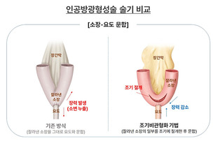 인공방광 수술, 순서 바꾸니 요누출 감소…‘장력 변수’ 주목