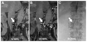 고난도 림프절 주사 대신 혈관 주사로…MRI 림프관 검사 간소화 가능성 확인