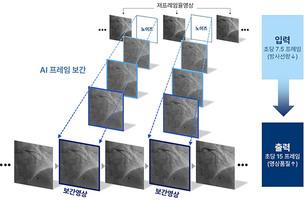 관상동맥조영술, AI로 저프레임 영상 품질 높여&hellip;방사선 저감 가능성 제시